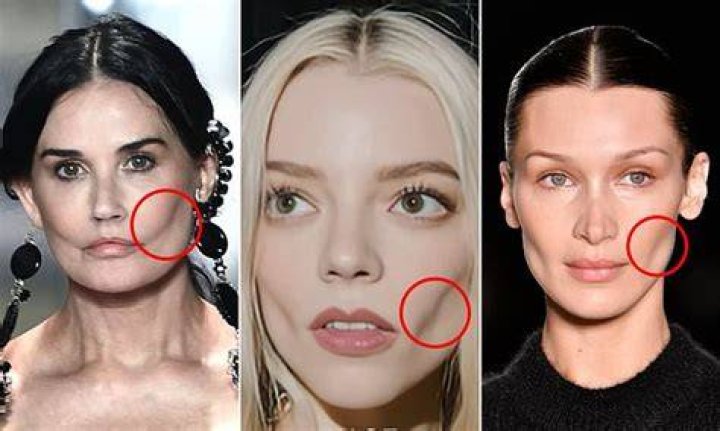 Buccal Fat Removal Celeb: The Ultimate Guide to Achieving a Slimmer Facial Contour