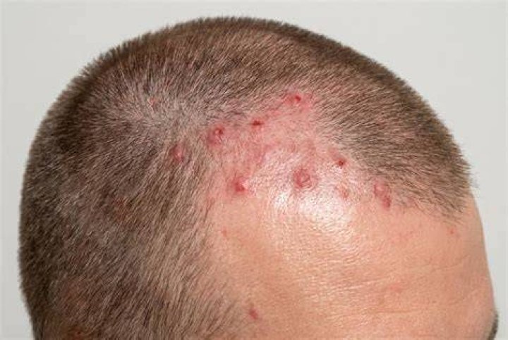 Does Bump Stopper Cause Hair Loss? Exploring the Truth Behind This Common Concern