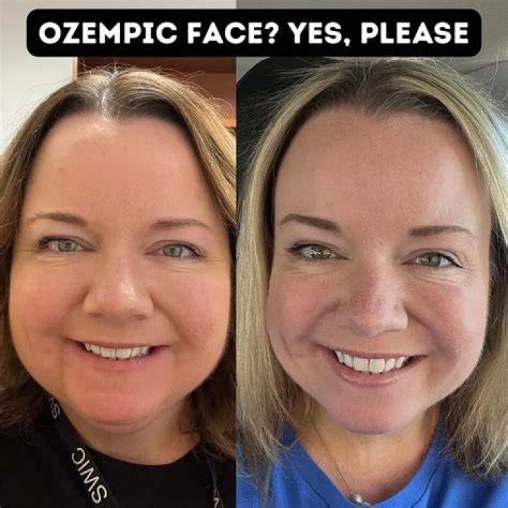 Ozempic Face Before and After: Unveiling the Transformation