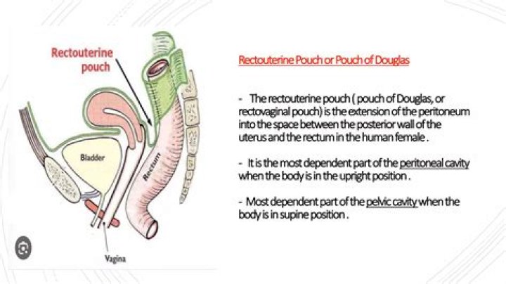 What is a Pouch of Douglas: A Comprehensive Guide to Understanding the Cul-de-sac of the Peritoneum