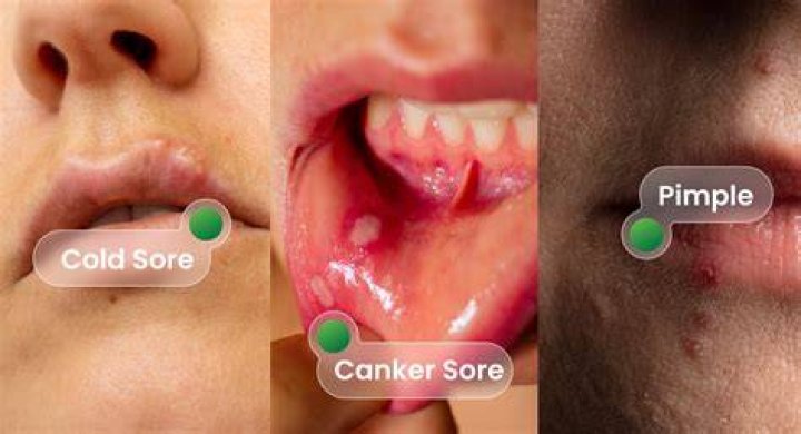 Will a Cold Sore Pop? Understanding the Myths and Realities
